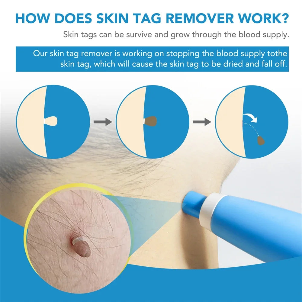 2-in-1 Skin Tag Remover Kit – Micro & Standard Mole/Wart Tool
