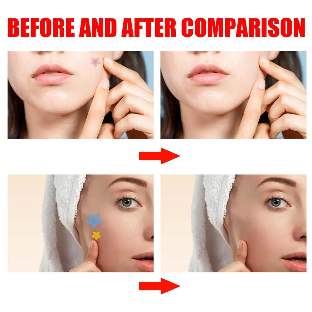 200pcs Colorful Cute Star & Heart Shaped Acne Treatment Stickers – Invisible Pimple Patches for Skincare